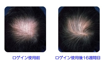 ロゲイン（ミノキシジル外用薬） | 発毛効果の 